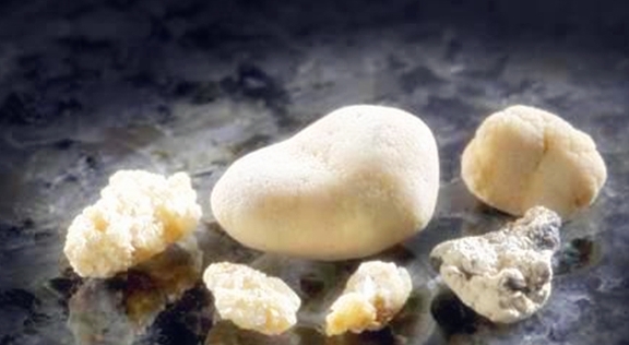 治疗|肾结石，真的可以自己排出来吗？你或许真的不知道，看专家的理解