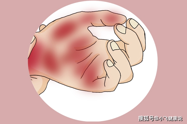 肝脏|从乙肝到肝纤维化,身体是会有“提醒”的,及时发现,或可阻止