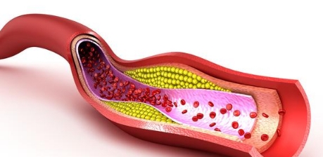 他汀|低密度脂蛋白降到1.0以下斑块能缩小?这2个指标也达标才行