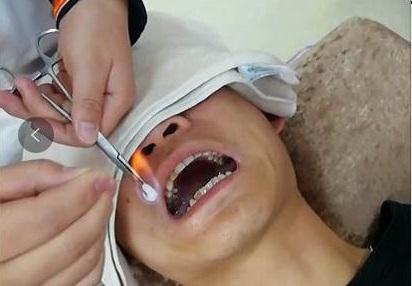 左侧口眼歪斜2月.