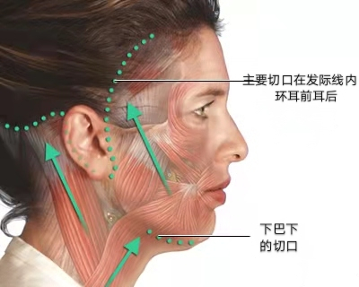 什么|过来人经验分享，给想做拉皮手术的人几句忠告