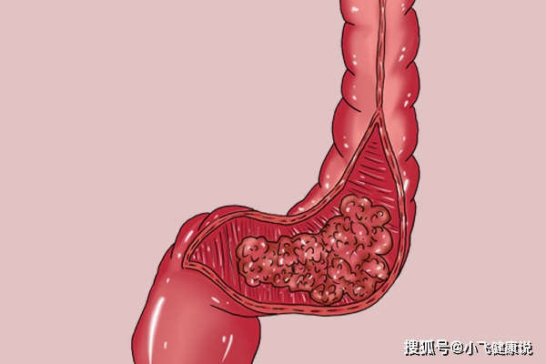 严重|恶性肿瘤到达前，其实已经提醒过你了，别忽视身体出现的反常变化
