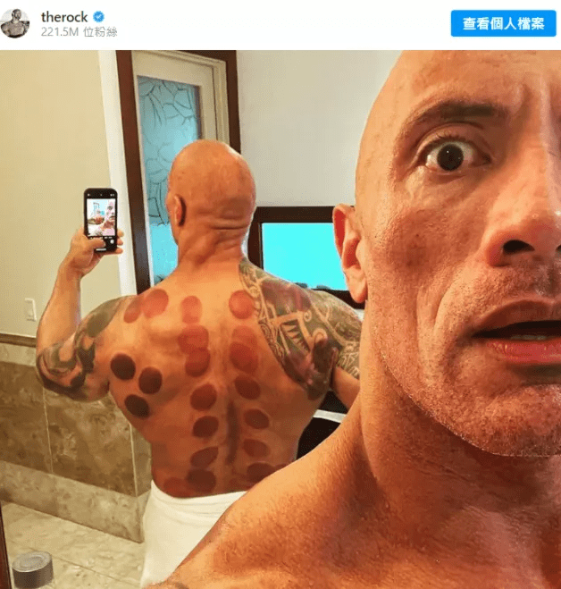 文化|这届老外，终于知道拔罐的秘密了？