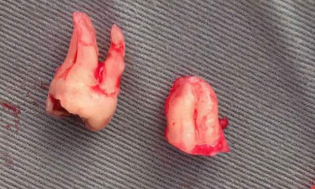 牛奶|新密互齿家口腔，怎么拔牙不那么痛苦