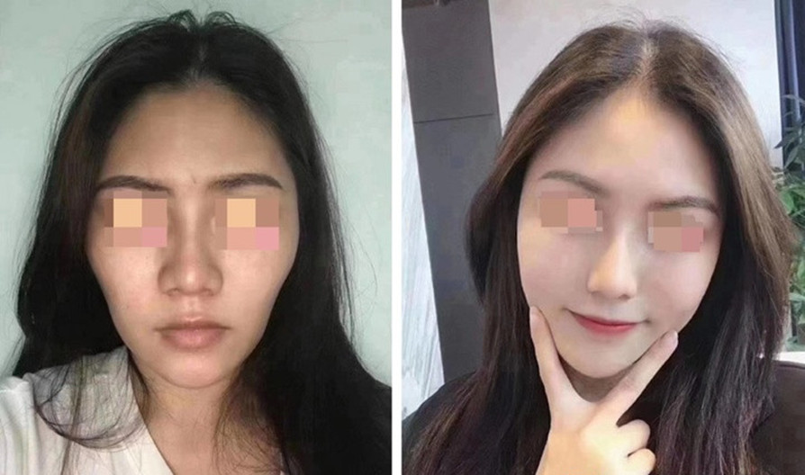 什么|面部抗衰 线雕适合哪些人做？禁忌是什么？线雕修复有多难？