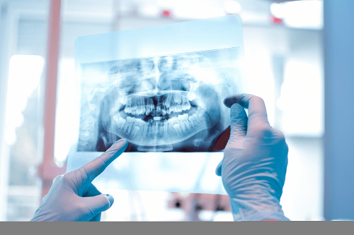 材料|成年人的正畸之选--透舒丽隐形牙套