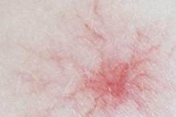 肝脏|肝脏不好的人，身上可能会出现“3红3黄”，或许多数人大意了