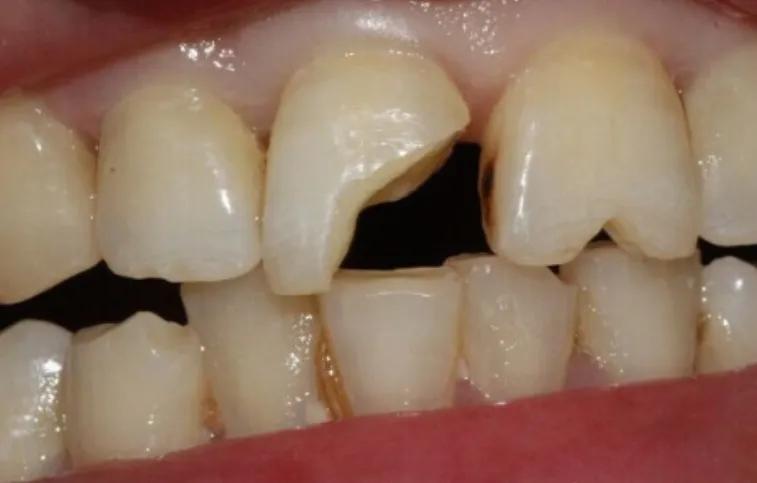 上门牙不小心磕掉一块,露齿影响美观怎么办?_牙齿