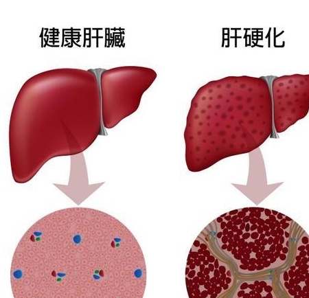 毒素|43岁男子深夜腹部疼，竟是肝硬化，提醒：日常2件事，是“大忌”