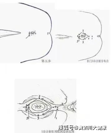 其中"肛周局麻的五步注射法"通过渗透式麻醉手法,能够极大程度缓解