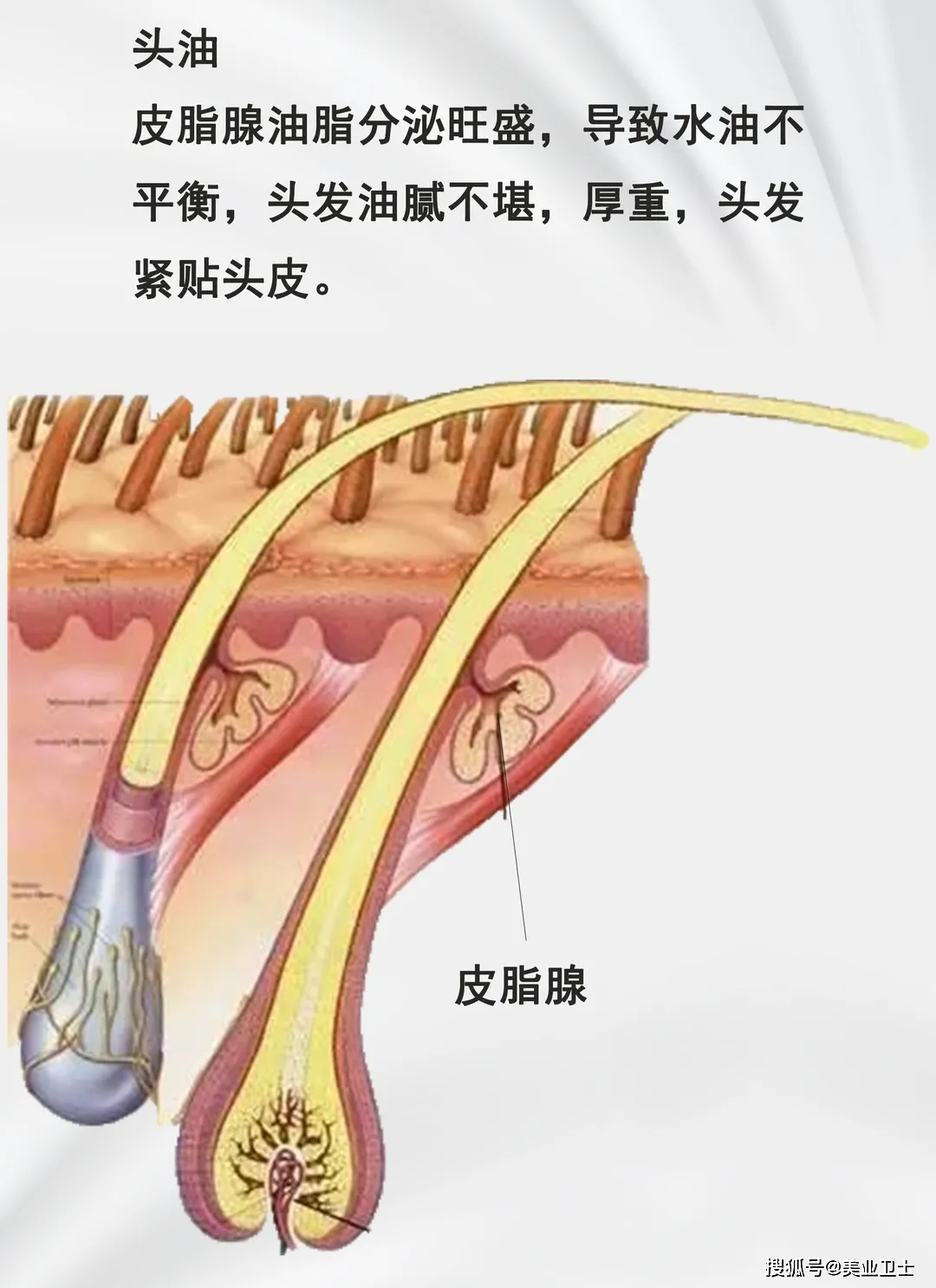 5种头皮问题你是属于哪种