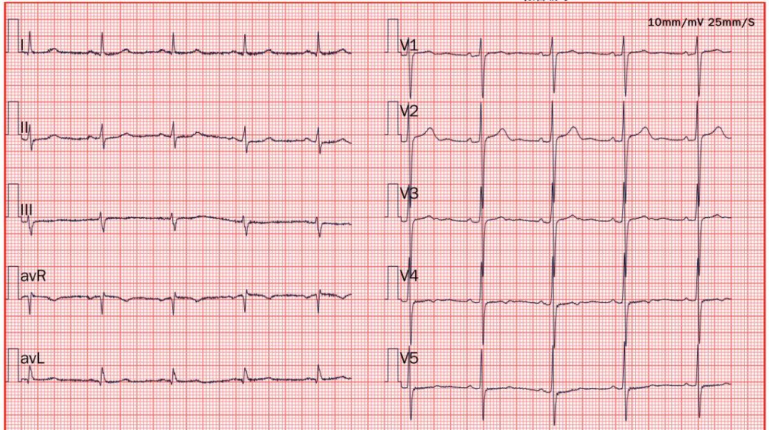 造影|45岁女性急性心梗，开始医生也有所怀疑，最后找到了原因