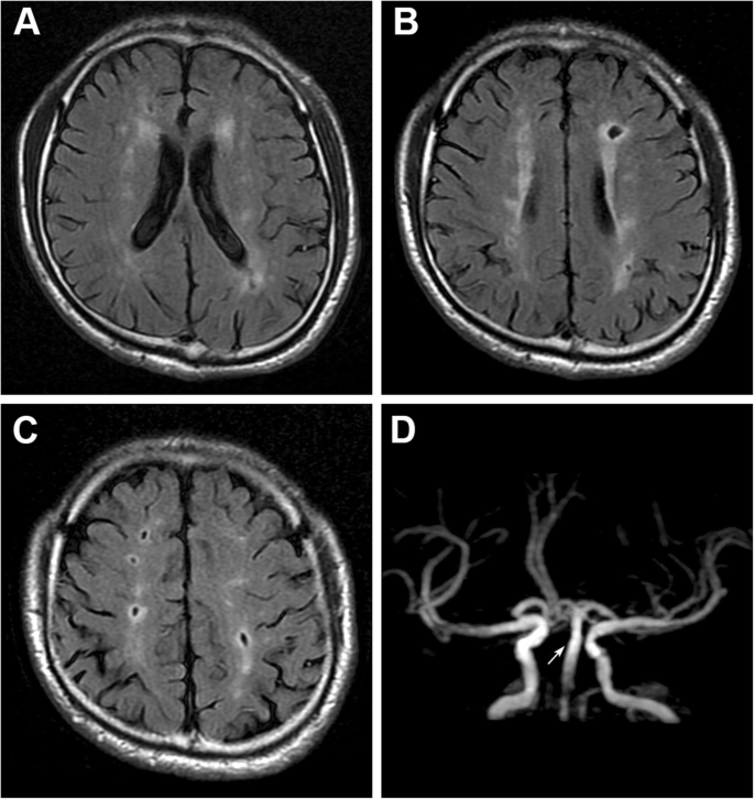 生活|45岁发现“腔梗”？医生帮忙分析，原因在于4个习惯，你可能也有