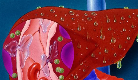 症状|肝硬化越来越多!医生:肝硬化到肝癌,身体会给3次机会,要珍惜