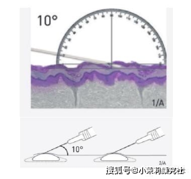 治疗|美容界的新宠，开启美容抗衰新高度