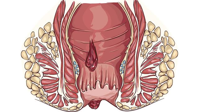 津液|程一乘博士-秋季肛周脓肿频发，干燥天气是元凶？预防手段不可少