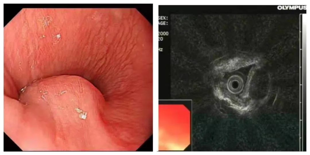 肿瘤|食管壁内“挖土豆” 肿瘤切除不留痕