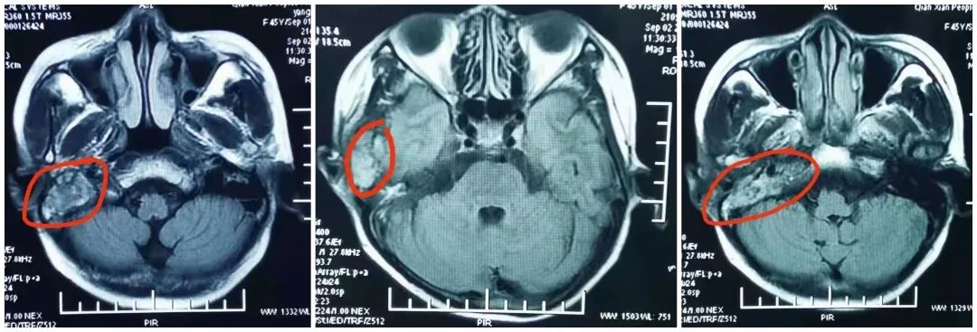 肿瘤|咸阳市中心医院开展不开刀颅内肿瘤放射性粒子植入术