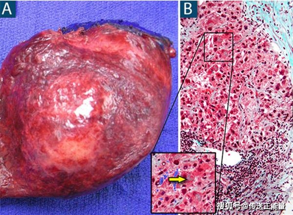 症状|肝内有癌，身体先知！身体若有这些“信号”，不妨留意一下