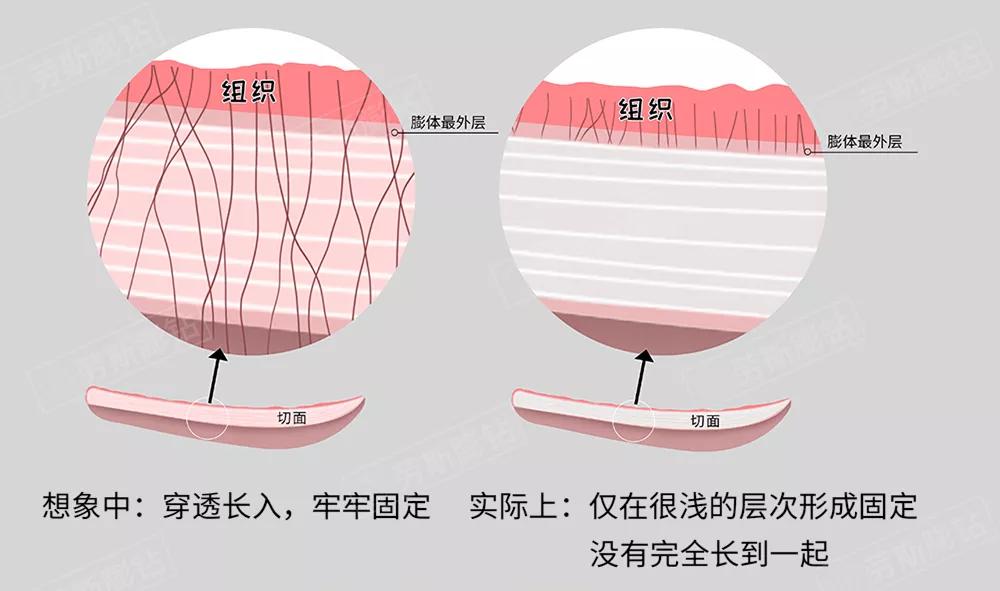 人体|一次搞懂！鼻整形人工材料选择攻略~