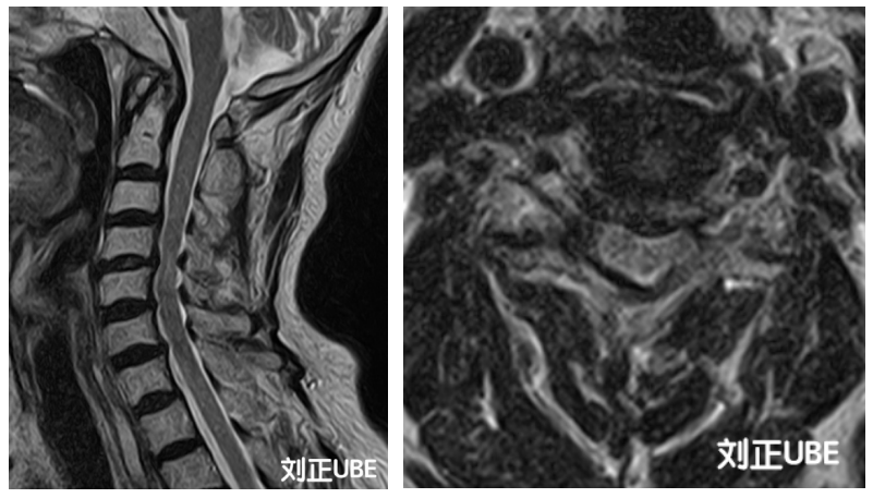 技术|颈椎问题，微创帮您解除困扰！