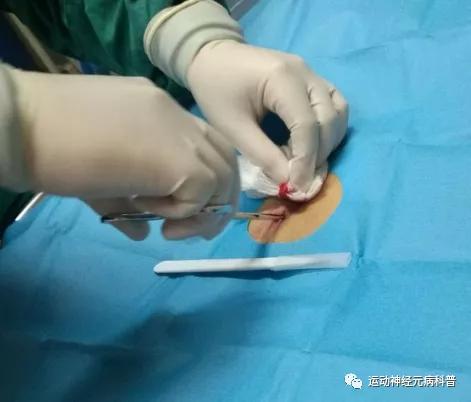 饮食|运动神经元的肠内营养管理