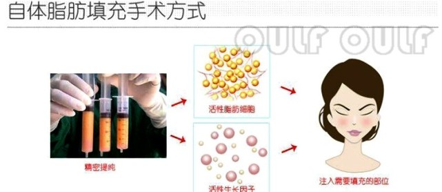 脸部|脂肪胶填充脸部可以维持多久？面部脂肪胶填充能管多久？想知道的看看