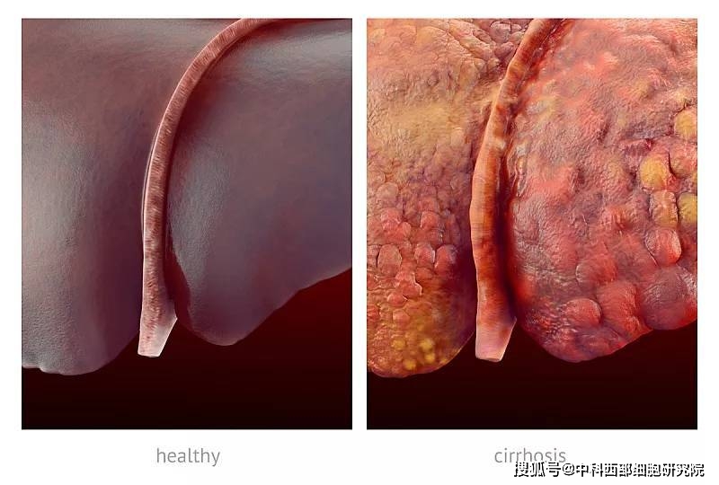 治疗|中科西部干细胞研究院：不同移植途径干细胞疗法治疗肝硬化研究案例