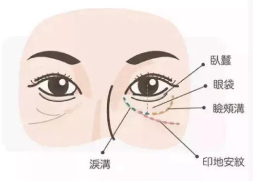 玛吉磨皮滤镜都去不掉的泪沟，还有救么？