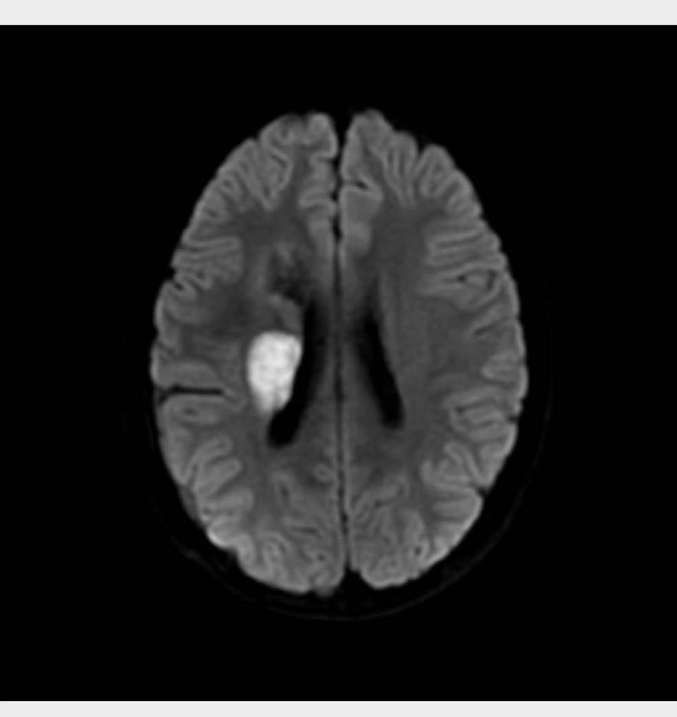 陕西省|西安交大一附院联合陕西省妇女儿童发展基金会救治双胎脑梗少年