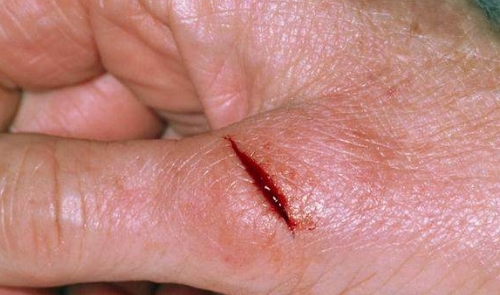 伤口|发现自己有糖尿病倾向怎么办？医生：多吃3种食物可自救！