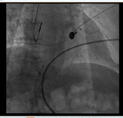 技术|心乱如麻 何以解忧—— 我院临时起搏器+希氏束起搏手术成功实施