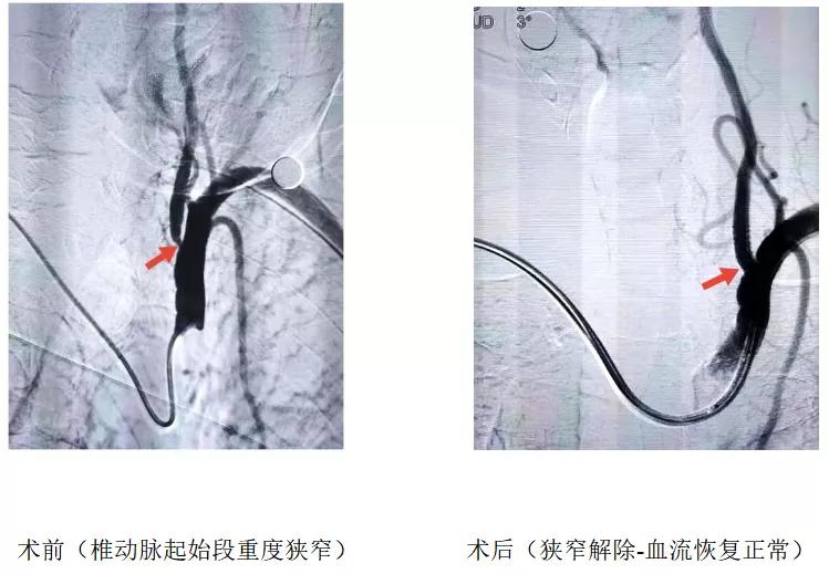血管|北京老年医院成功完成经桡动脉入路椎动脉狭窄支架置入术