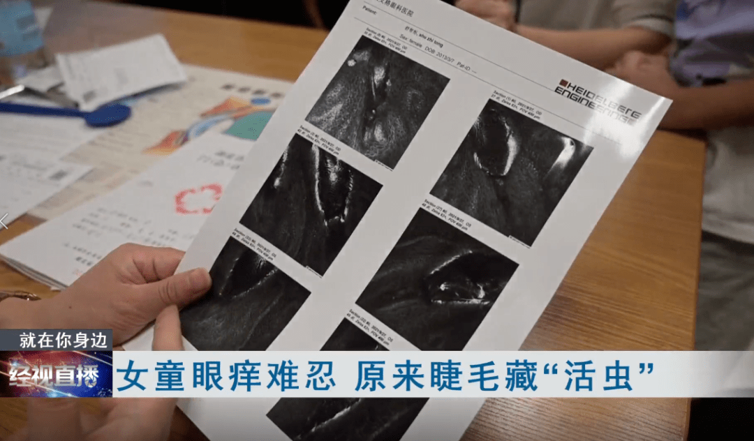 家长|眼睛奇痒，10岁女孩拔光睫毛，元凶竟是它