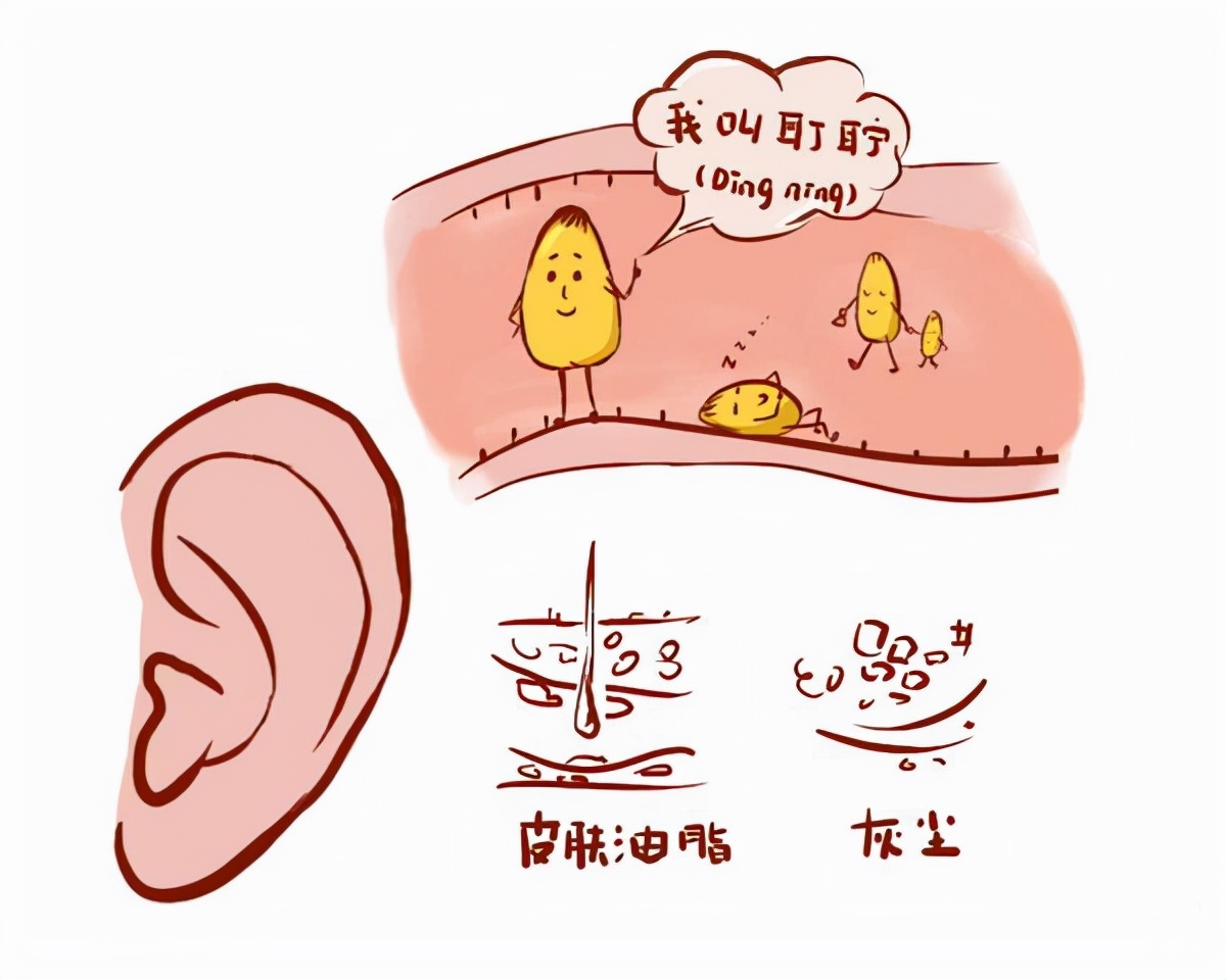 频繁掏耳朵,医生眼中的好处只有这一个!_耳屎