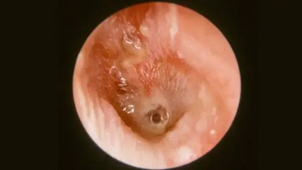 民生|成都民生耳鼻喉医院治耳痛耳流脓效果 专治耳鼻喉