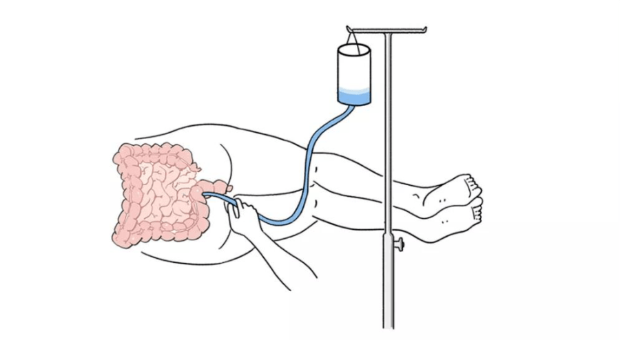 肠灌图片