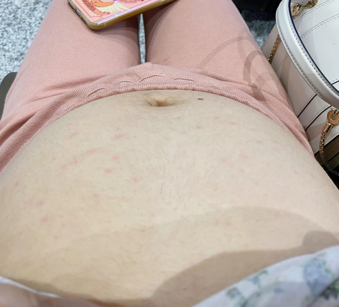 妊娠纹预防指南 怀孕到产后 孕妈不可错过的几种方法 快收藏 皮肤