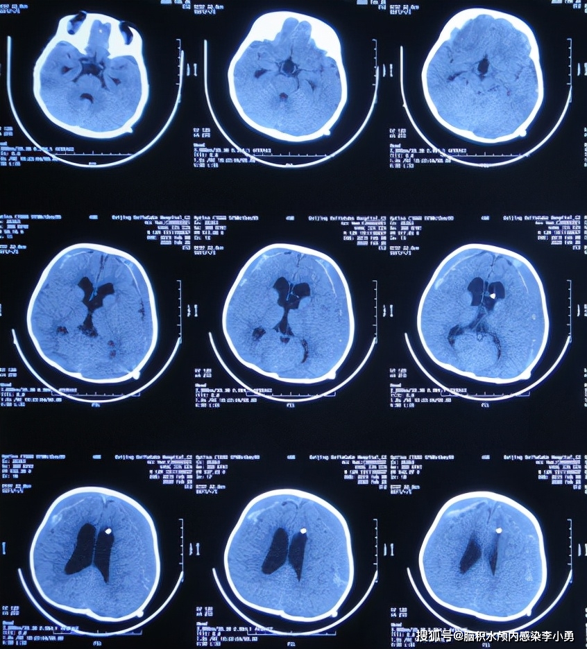 9個月大嬰兒查出腦積水後及時治療現在近3歲身體智力一切正常