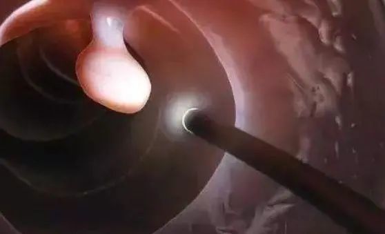 一般多少岁建议做肠镜 c20f7b591b6f4c658b098cc77eafe216.jpeg