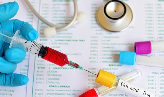 尿酸|尿酸高的人，身体若有这3个“变化”，可能已经“连累”到肾脏了