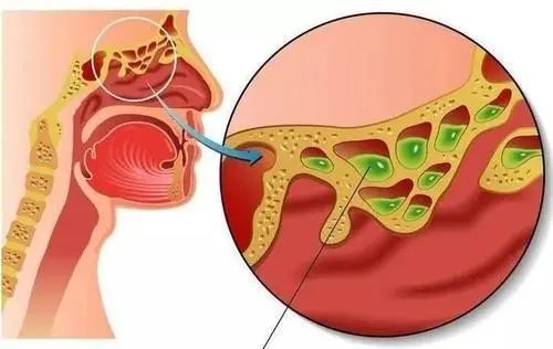 (点石师爷)王永月医生谈腺样体肥大和鼻窦炎的关系