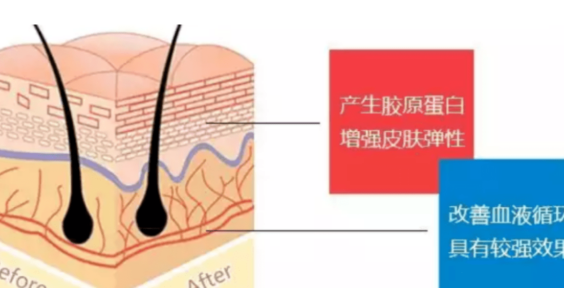 眼袋蛋白线埋线去眼袋好吗 如何去眼袋最好呢？