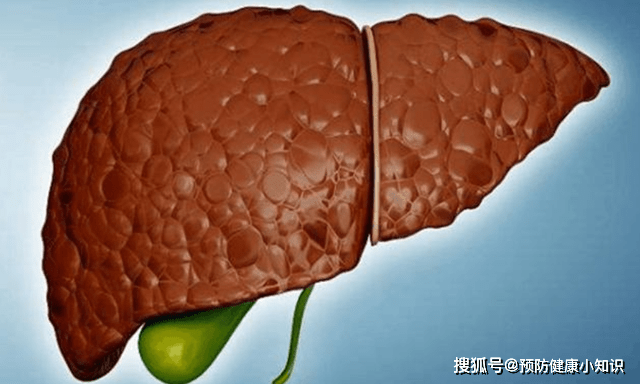 肝脏|肝癌早期不痛不痒，别不信：若出现“2黄1红”，别拖了，早查肝CT