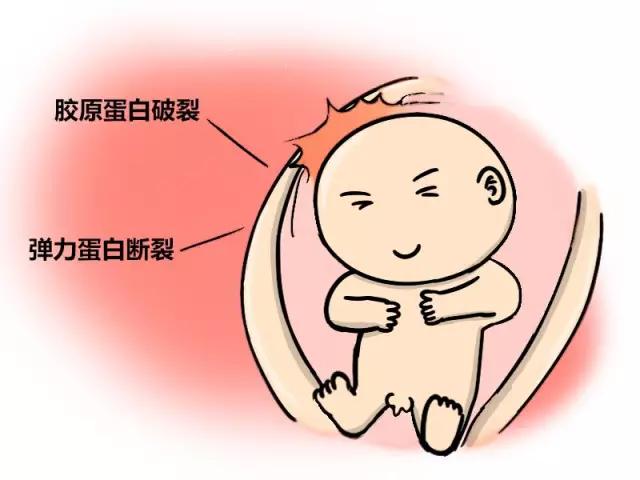 孕妇长妊娠纹怎么办