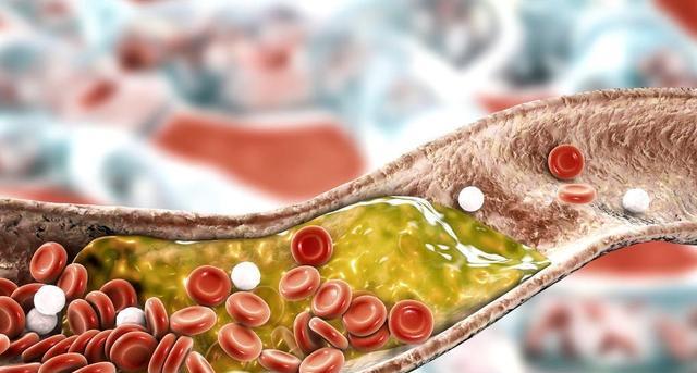 治疗|患了脑梗之后，一直在吃“他汀”，血脂正常了能不能停？