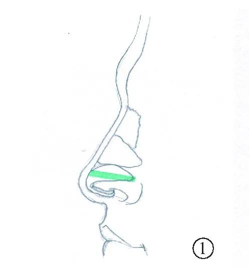 手术|如何do鼻子才能有好的效果？