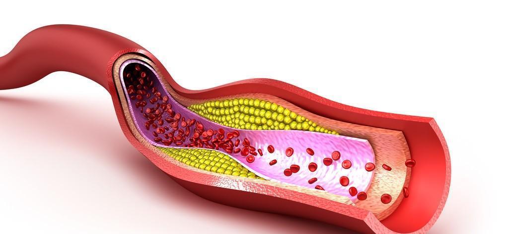 血脂|吃他汀类药物,血糖高了怎么办?停药之后血糖还会正常么?