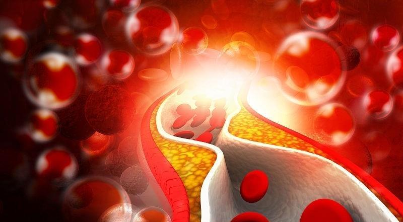 血液|有的人血压、血脂、血糖都不高，为什么也会患脑梗死？