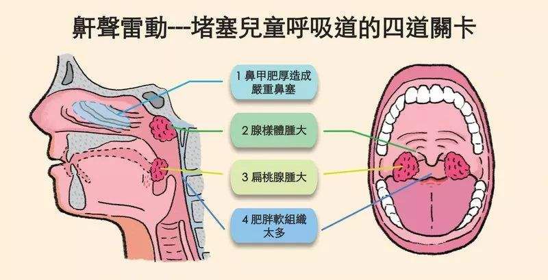 腺样体亦称咽扁桃体,增殖体,是位于鼻咽顶后壁中线处的一块较大的淋巴